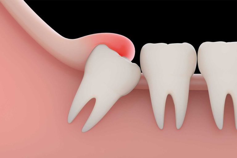 how much does it cost to remove wisdom teeth