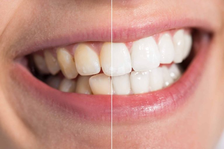 how to get rid of stains on teeth