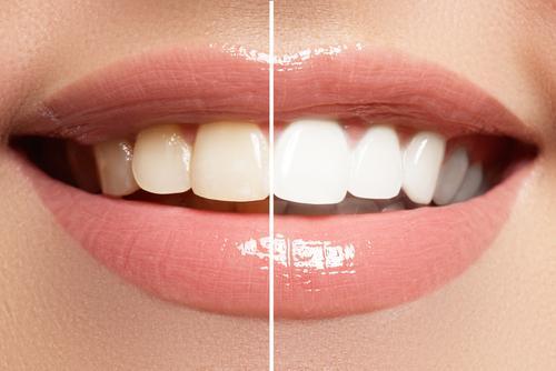 how to whiten teeth